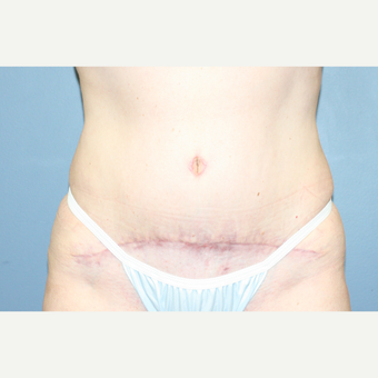 Tummy Tuck with Muscle Repair and Laser Liposuction after 3610183