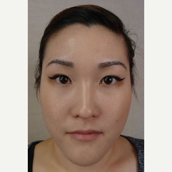 35-44 year old woman treated with Eyebrow Transplant after 3371906
