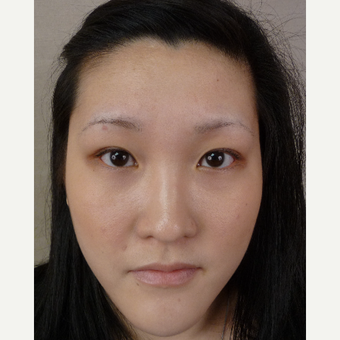 35-44 year old woman treated with Eyebrow Transplant before 3371906