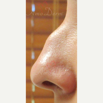 25-34 year old woman treated with Non Surgical Nose Job before 3381451