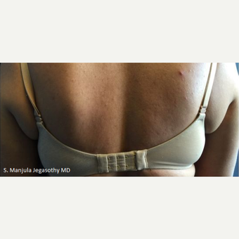 Treat Stubborn Back Fat With Kybella® before 2549837