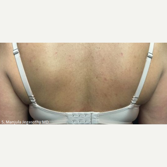 Treat Stubborn Back Fat With Kybella® after 2549837