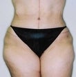 34 year old female patient after 934782