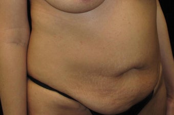 40 year old woman treated with Tummy Tuck 3092913