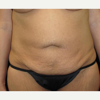 40 year old woman treated with Tummy Tuck before 3092913