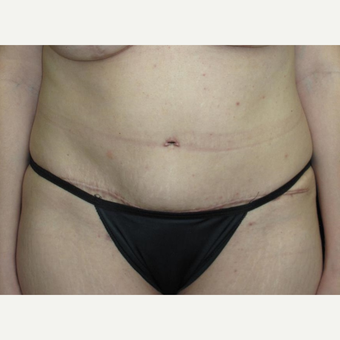 40 year old woman treated with Tummy Tuck after 3092913