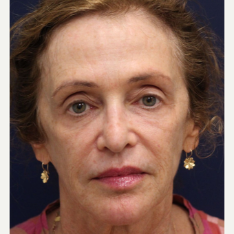 55-64 year old woman treated with Bellafill before 3243148