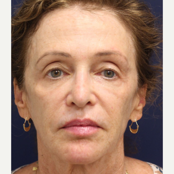 55-64 year old woman treated with Bellafill after 3243148