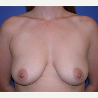 25-34 year old woman treated with Breast Augmentation before 1581165