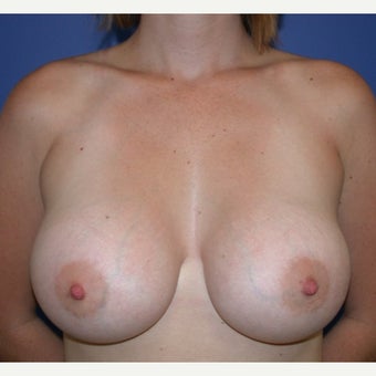 25-34 year old woman treated with Breast Augmentation after 1581165