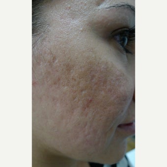 Multiple treatments for most difficult scars before 2559530