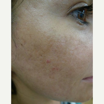 Multiple treatments for most difficult scars after 2559530