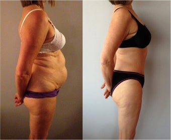 Abdominoplasty / Tummy Tuck Before & After before 792995