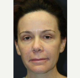 43 year old woman treated with Restylane before 1555630