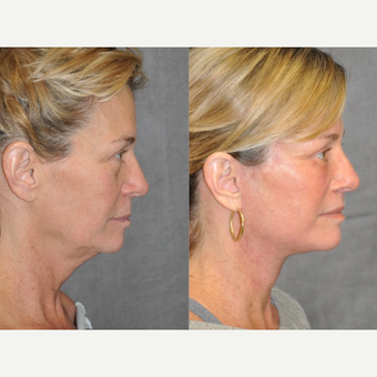 45-54 year old woman treated with Facelift before 3180742