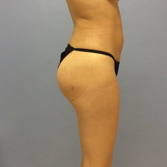 25-34 year old woman treated with Brazilian Butt Lift after 3663808