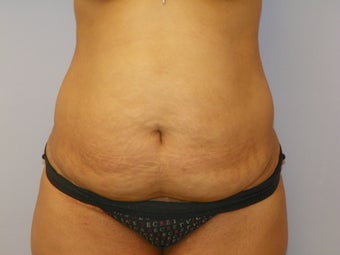 Tummy Tuck before 1191501