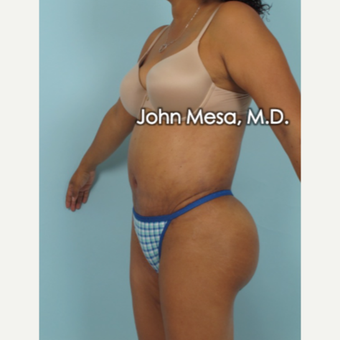 35-44 year old man treated with Brazilian Butt Lift after 3777665