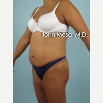35-44 year old man treated with Brazilian Butt Lift before 3777665
