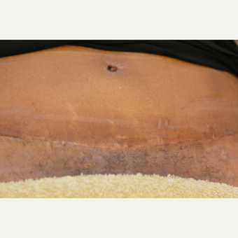 45 year old Tummy Tuck patient treated with Embrace Scar Therapy after 3522193