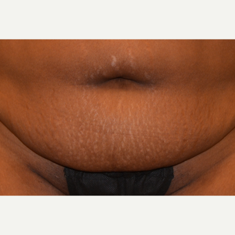 45 year old Tummy Tuck patient treated with Embrace Scar Therapy before 3522193