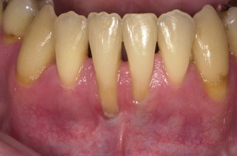 53 year old male treated for mucogingival defect before 1493911