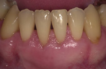53 year old male treated for mucogingival defect after 1493911