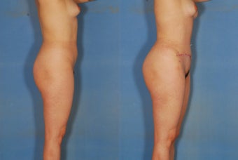 Abdominoplasty, liposuction of flanks and back, and fat injections to the buttocks. before 266481