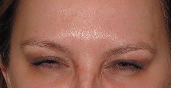 32 year old female for frown lines after 1389562