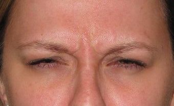 32 year old female for frown lines before 1389562