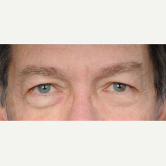 66 year old man treated with upper lower blepharoplasty before 3465782