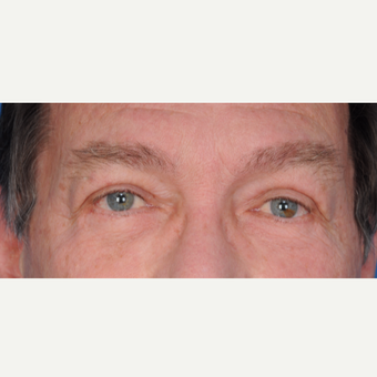 66 year old man treated with upper lower blepharoplasty after 3465782