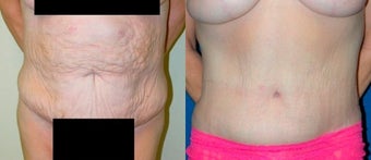 Tummy Tuck before 3037938