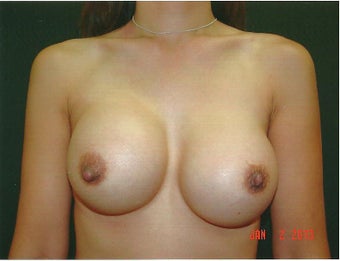 Breast Augmentation Revision using Mentor Smooth Silicone Moderate Plus before 1060076