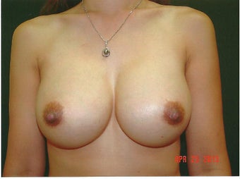 Breast Augmentation Revision using Mentor Smooth Silicone Moderate Plus after 1060076