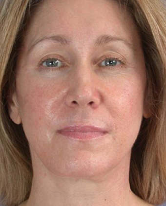 45-54 year old woman treated with Neck Lift after 1677115