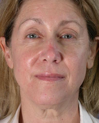 45-54 year old woman treated with Neck Lift before 1677115