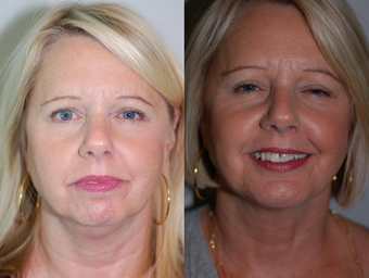 Neck Liposuction before 1182887