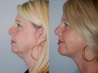 Neck Liposuction after 1182887