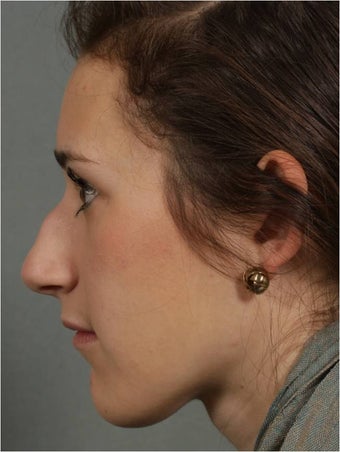 19 year old female, Italian descent, looking to reduce her dorsal hump, lift and refine her nasal tip 1017808