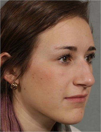 19 year old female, Italian descent, looking to reduce her dorsal hump, lift and refine her nasal tip before 1017808