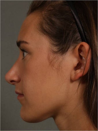 19 year old female, Italian descent, looking to reduce her dorsal hump, lift and refine her nasal tip 1017808