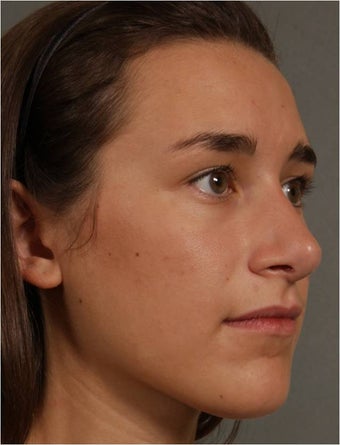 19 year old female, Italian descent, looking to reduce her dorsal hump, lift and refine her nasal tip after 1017808