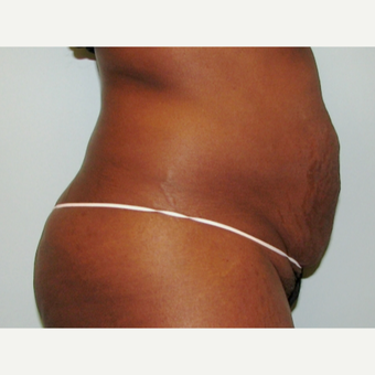 Tummy tuck performed in conjunction with hysterectomy. before 3365849