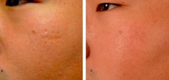 18-24 year old man treated with Microneedling before 2059267