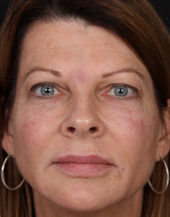 Filler for Under-Eye Hollows after 1358661