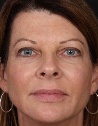 Filler for Under-Eye Hollows before 1358661