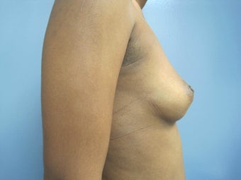 35-44 year old woman treated with Breast Augmentation 2779976