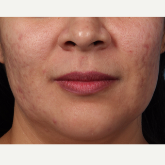 25-34 year old woman treated with Acne Scars Treatment before 3321131