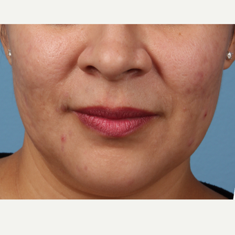 25-34 year old woman treated with Acne Scars Treatment after 3321131